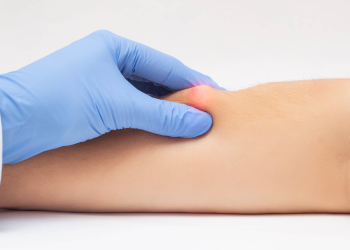 شناخت بیماری لیپوم علائم و درمان آن