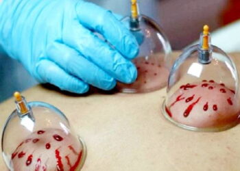 هشت مزیت حجامت