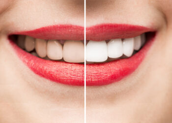 10 روش طبیعی برای سفید کردن دندان در خانه